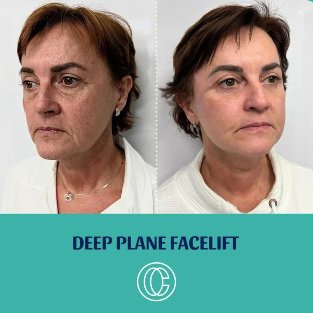 Deep plane facelift a plastika dolných viečok - transkonjunktiválne. #facelift #deepplanefacelift #plastickychirurg #antiage @dr.paliatka